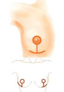 mamoplastiaredutora-em-saopaulo