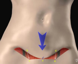 mini abdominoplastia