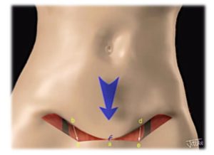 miniabdominoplastia cicatriz