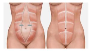 miniabdominoplastia diastase