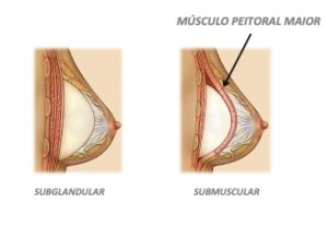 proteses submuscular