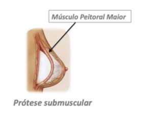 prótese submuscular